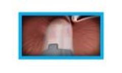 TIF 2.0 procedure with EsophyX Z device - Video