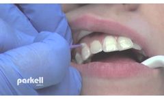 Desensitizing tooth surfaces using Brush&Bond or Pain-Free F. - Video