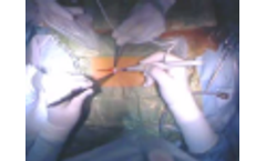 Surgical microwave ablation in the liver - Video