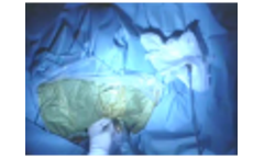 Minimally invasive microwave ablation in the liver - Video