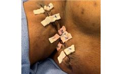 Myriad Matrix - Engineered Extracellular Matrix for Hidradenitis SuppurativaClinical Resource