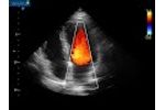 MR 4 Chamber - Lambda P9 Cardiovascular Ultrasound - Video