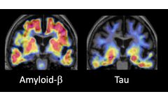 Veravas and Tymora Collaborate on Early Detection Alzheimer’s Testing