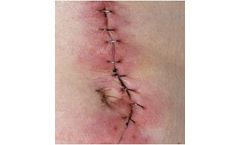 IonoStim - Wound Healing Clinical Pipeline
