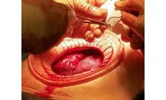 Asept - Wound Protector/Retractor
