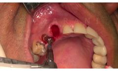 Benex Control - How to - Video