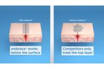 See How embrace® is Redefining Scar Therapy - Video