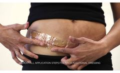 embrace® Active Scar Defense Application | Abdominoplasty - Video