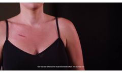 embrace® Active Scar Defense Application | Port Scar - Video