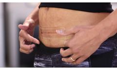 embrace® Active Scar Defense Application | C-Section - Video
