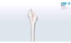 SP-CL surgical technique EN 02-2015 - Video