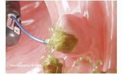 G-Flex Stonetrigger - Stone Extraction Balloon