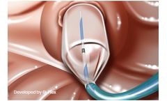 G-Flex Precision - Progressive Dilation Ballon