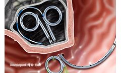 G-Flex - Cystostome and Pseudocyst Drainage