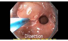 ClearEndoClip - Video