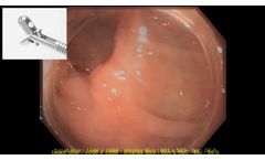 FINEMEDIX ClearTip needle visibility - Video