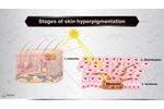 What is skin hyperpigmentation ? - Vdieo