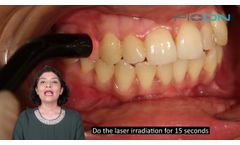 Management of Dentinal Hypersensitivity - Video