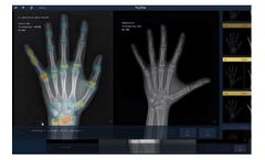 VUNO Med-BoneAge - X-ray Image Analysis Software