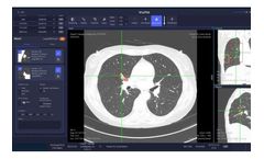 Vuno Med - Version LungCT AI - Chest CT Data Analysis Software