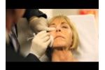 DermaSculpt Microcannula for Injectable Fillers- Bruiseless Fillers - Video