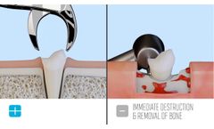 Piezotome CUBE vs Rotary Burr - Video