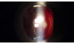 HD Capsulotomy with TCI, Performed and Narrated by Dr. Paul I. Singh - Video