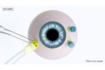 EVA AVETA??? trocar cannula system by DORC - Video