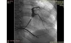 Omega Cardiac Loop - Video