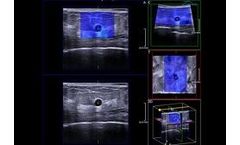 Ultrasound System for Breast Cancer Patients