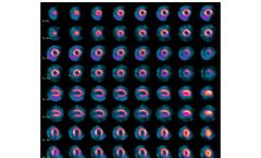 D-SPECT for Clinical Care - Myocardial Perfusion