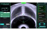 AquaBeam Robotic System - Personalized Treatment Planning, Transverse View 2019 - Video