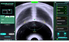 AquaBeam Robotic System - Personalized Treatment Planning, Transverse View 2019 - Video
