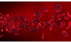 Understanding Stroke - Video