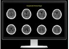 Rapid - Version ICH - Identifies Suspected Intracranial Hemorrhage Software