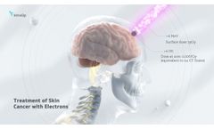 Benefits of Electrons vs X-rays for Treatment of Skin Cancer - Video