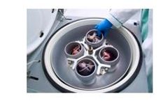 Acute Kidney Injury (AKI) Device for Reduction of Galectin-3 Levels