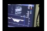 Femoral Vein Flow Using Duplex Ultrasound & Hands-Free Augmentation Device - Video