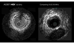 HDi - Circumflex Calcium - Video