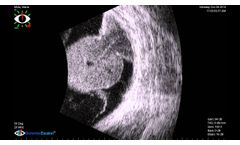 B-Scan Tumor with Vasculature - Video