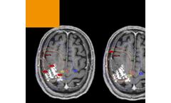 NBS - Navigated Brain Stimulation System for Radiotherapy