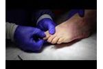 Centric Medical`s ROGUE Hammertoe Correction Device - Video