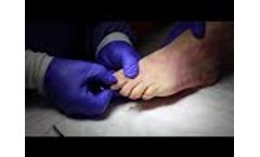 Centric Medical`s ROGUE Hammertoe Correction Device - Video