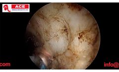 ACE HEMI Plasma Button Electrode - Video