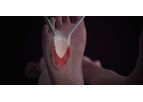 TheraSkin - Slow-Healing or Chronic Wound