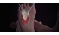 TheraSkin - Slow-Healing or Chronic Wound