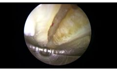 seg-WAY ECTR Procedure - Video