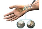 Seg-WAY - Model ECTR - Endoscopic Carpal Tunnel Release System