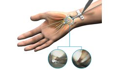 Seg-WAY - Model ECTR - Endoscopic Carpal Tunnel Release System