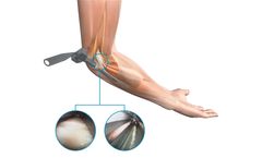 Seg-Way - Model ECuTR - Endoscopic Cubital Tunnel Release System